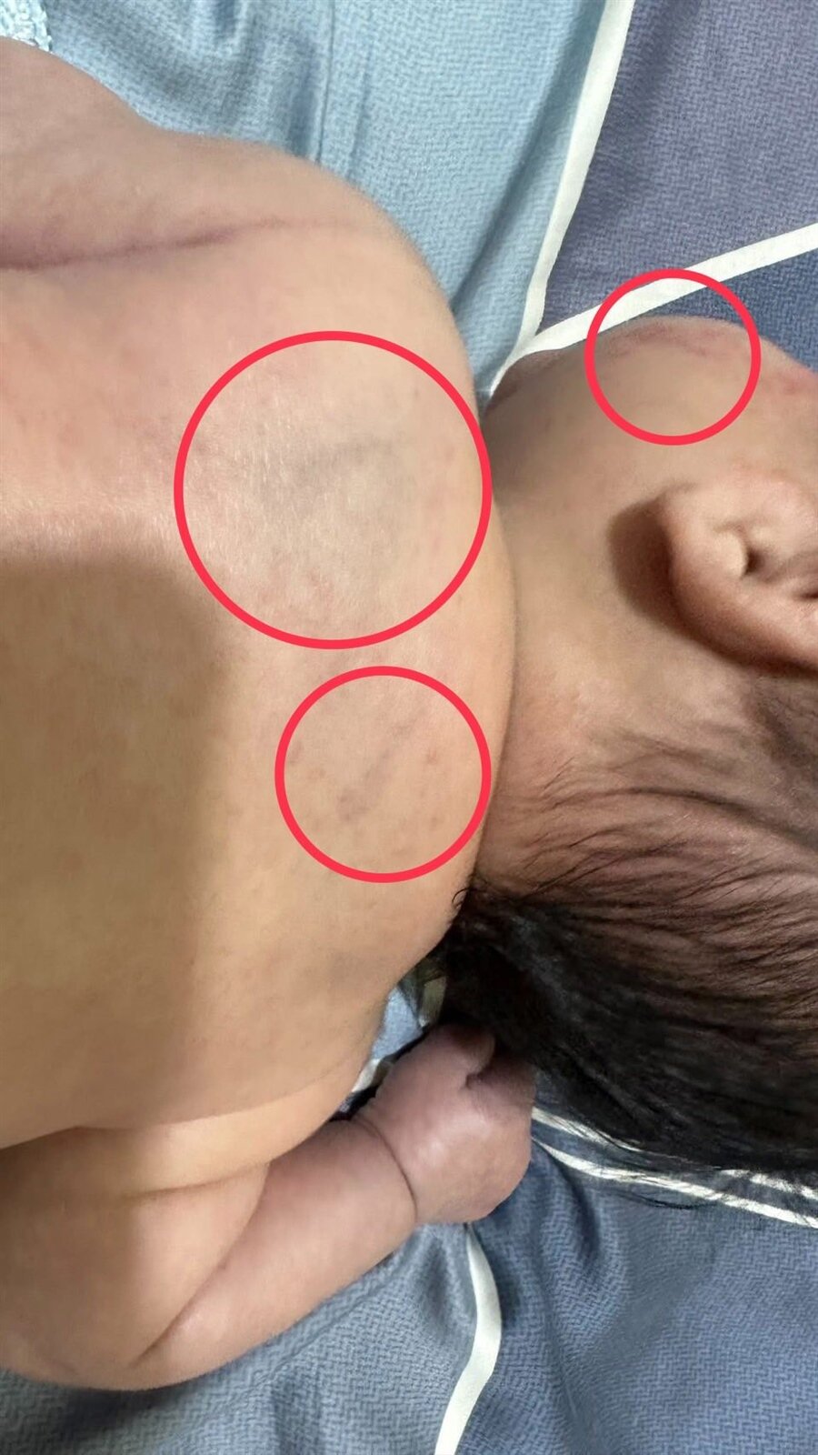 桃園市八德區近日傳出疑似保母虐嬰案件，孩童身上出現多處瘀青。圖：截自黃瓊慧臉書