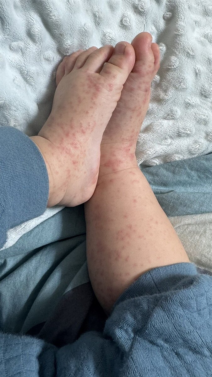 高雄市鼓山區某私立小學爆發腸病毒群聚感染，源頭疑似家長隱匿仍讓小孩到校上課，導致疫情擴散，害1歲嬰兒也中招，如今傳出疫情擴大。圖／讀者提供